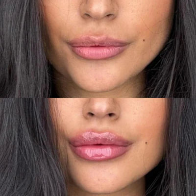 GlowLips™- Agrandisseur de lèvres